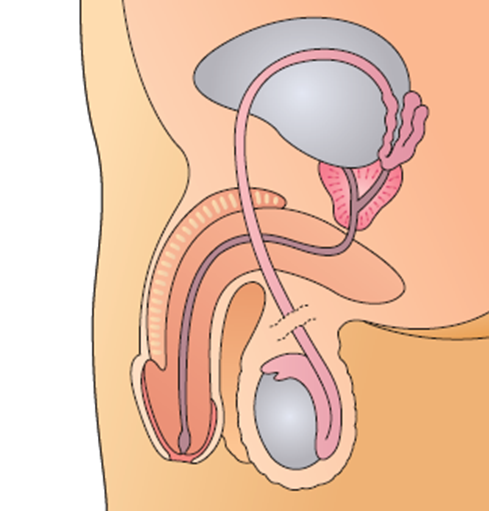 Bilaterale Vasectomie